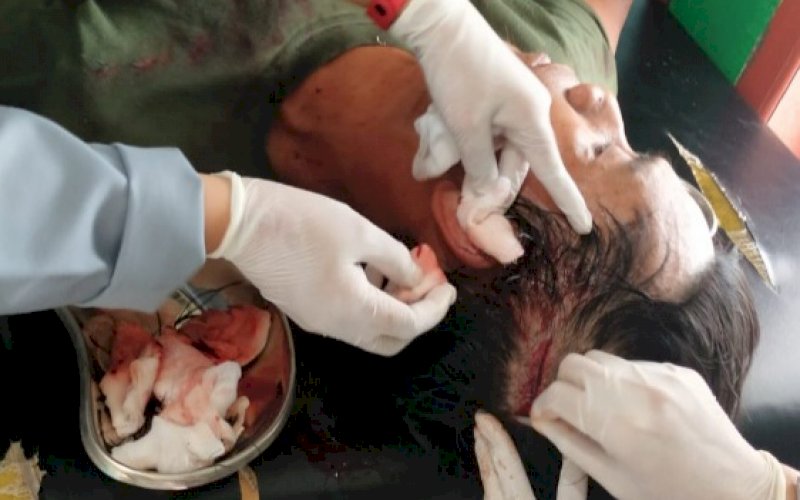 JALANI PERAWATAN. Muh Yusuf saat menjalani perawatan di Puskesmas. foto: istimewa